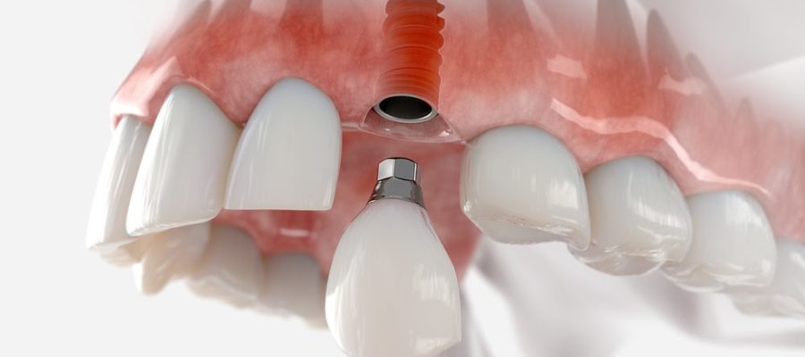 3D печать в производстве зубных имплантов